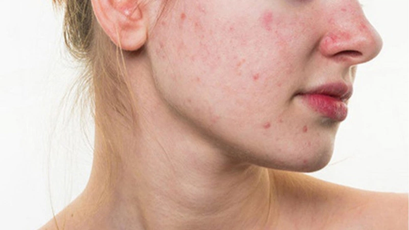 Mách chị em bí quyết trị mụn sau sinh bằng sữa mẹ 1