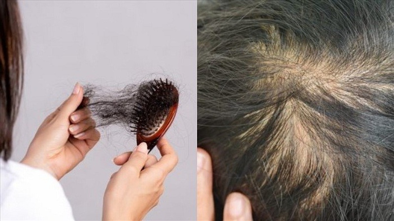 Lupus ban đỏ rụng tóc có nguy hiểm không? Làm thế nào để hạn chế tình trạng này? 3