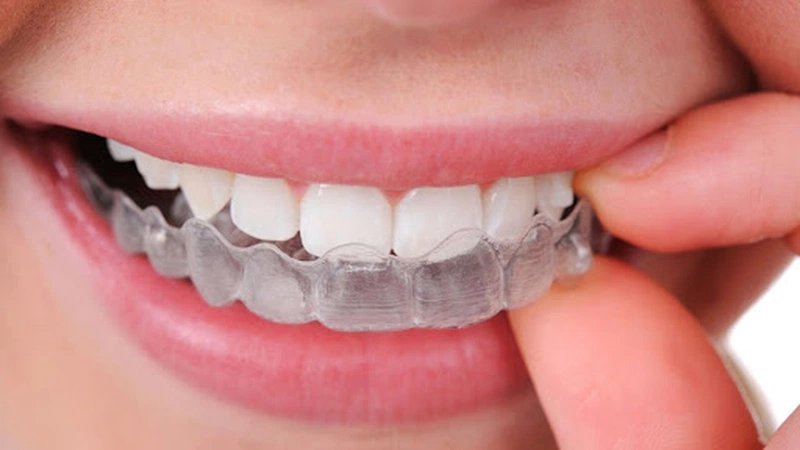 Điều trị nghiến răng bằng máng chống nghiến răng khi ngủ 2