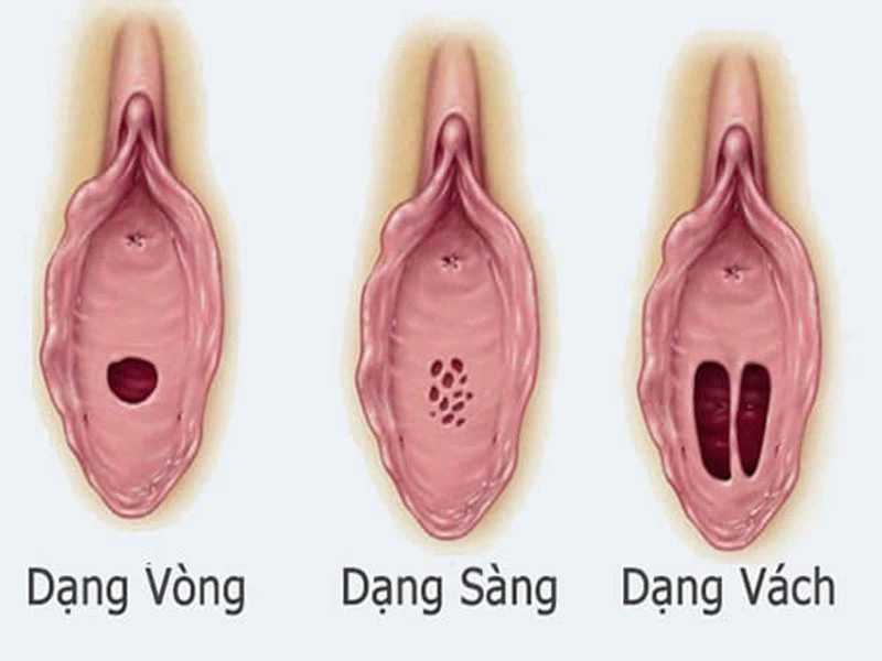 Bật mí cách nhận biết màng trinh còn hay rách 2