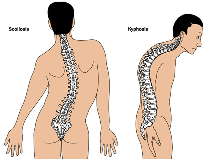 Hội chứng marfan: Nguyên nhân gây bệnh, triệu chứng, phương pháp chẩn đoán và điều trị