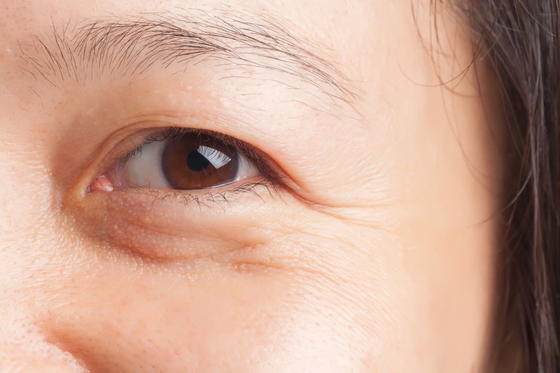 Nếp nhăn dưới mắt có dễ xóa không? Mẹo xóa nhăn vùng mắt hiệu quả 1