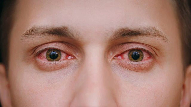 Mắt bị cộm khó chịu: Nguyên nhân và cách khắc phục2