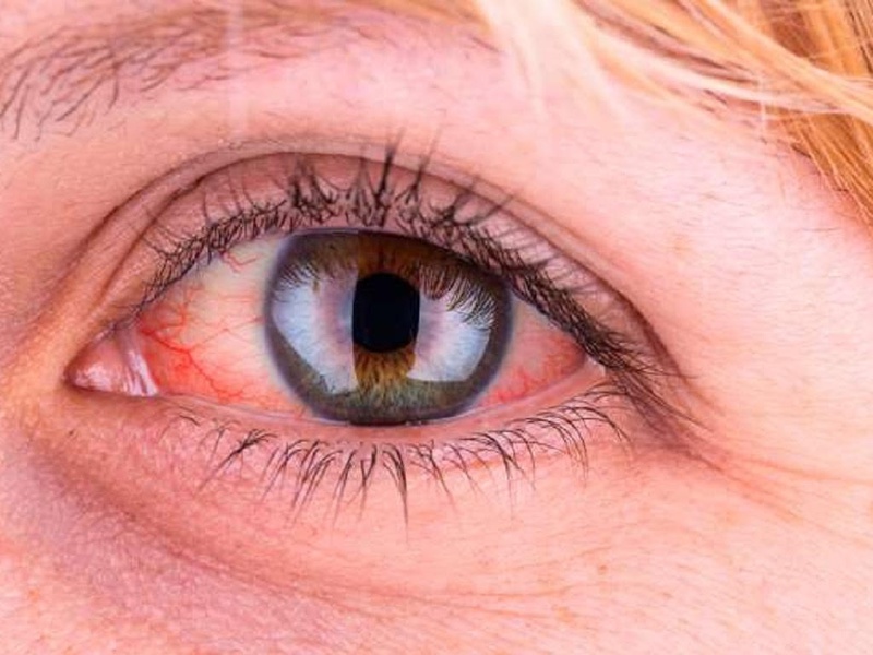 Mắt bị nổi gân máu đỏ là dấu hiệu của bệnh gì 1