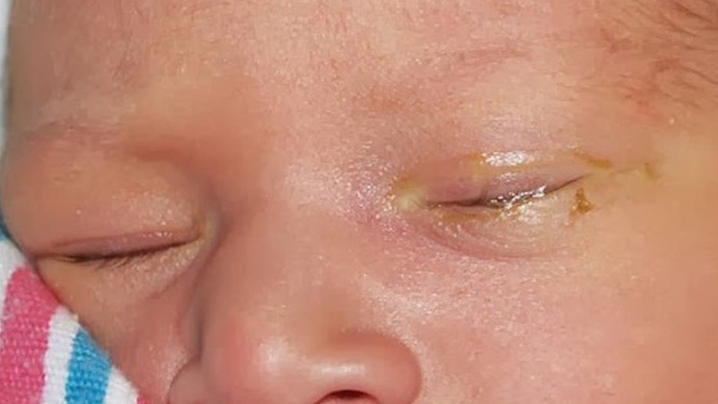 Mắt đổ ghèn sau sinh ở trẻ có nguy hiểm không? 1