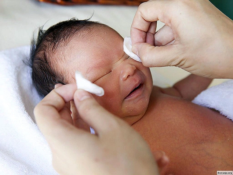 Mắt đổ ghèn sau sinh ở trẻ có nguy hiểm không? 3