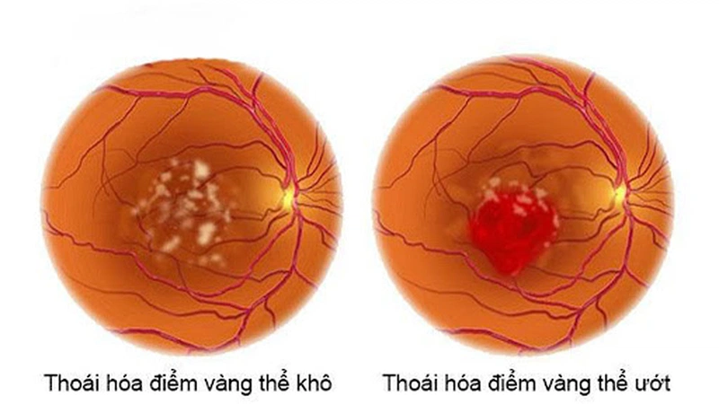 Mắt nhìn thấy gợn sóng và những điều cần biết khi mắc phải 2