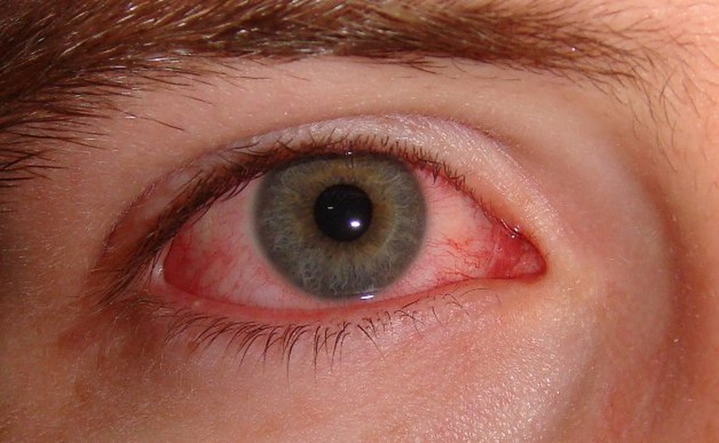 Mắt nổi gân đỏ: Nguyên nhân, triệu chứng và biện pháp phòng ngừa 1