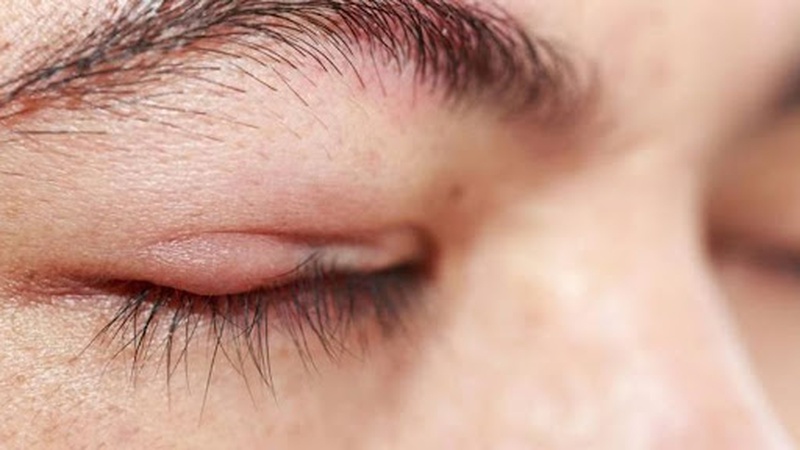 Mắt bị đỏ một bên nhưng không đau là vấn đề gì về mắt? 