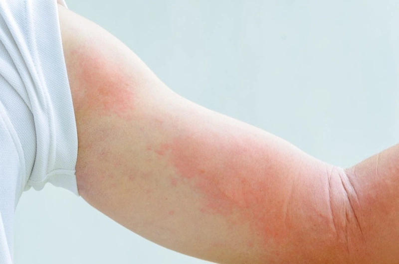 Mẹ bị nổi mề đay có nên cho con bú hay không 1