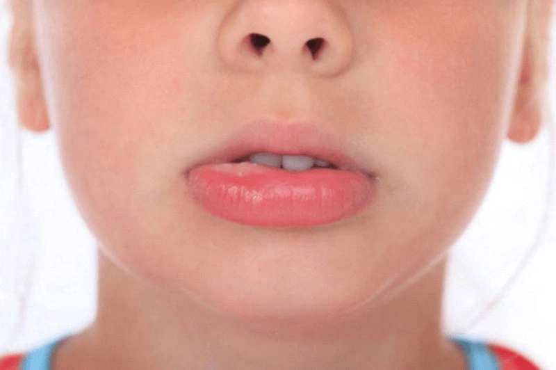 Mề đay sưng môi là bệnh thường gặp ở những người có sức khỏe yếu, cơ thể nhạy cảm
