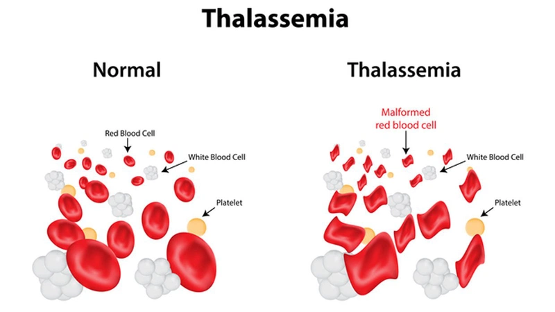 Mẹ mang gen Thalassemia bố bình thường thì con có sao không? 1