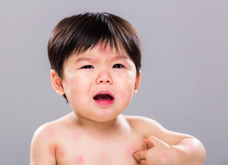 Mẹ nên làm gì khi trẻ sơ sinh bị sưng mí mắt trên? 2