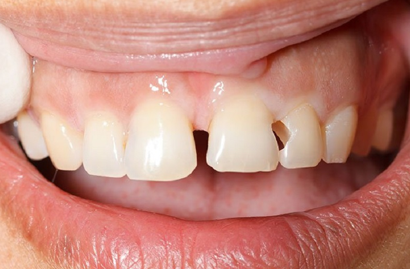Mẻ răng là gì? Răng bị mẻ phải làm sao để phục hình lại răng? 1