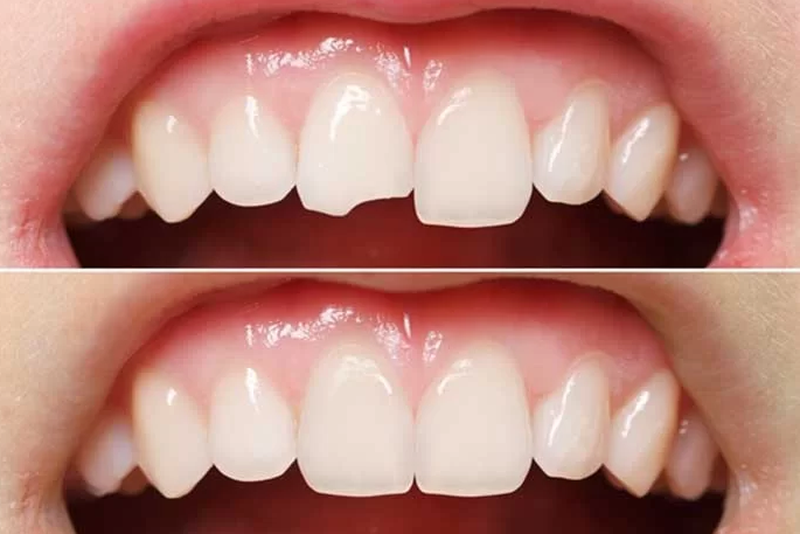 Mẻ răng là gì? Răng bị mẻ phải làm sao để phục hình lại răng? 2