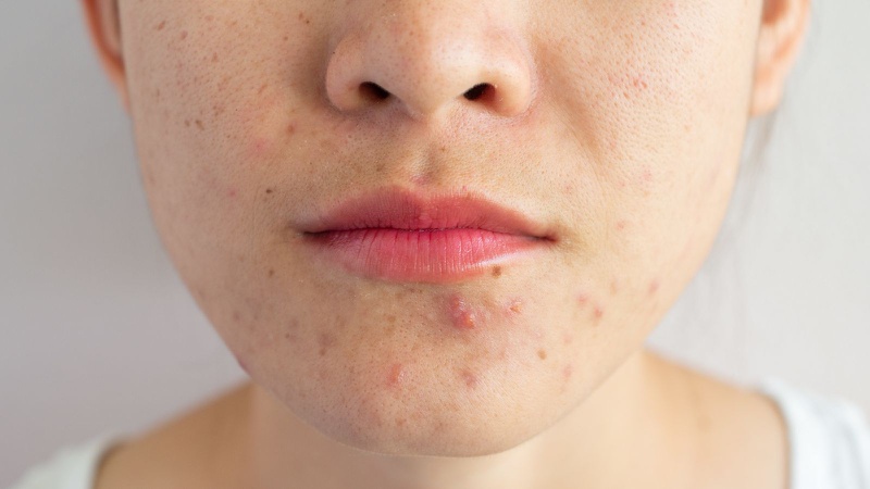 Megaduo có đẩy mụn không? Có tác dụng với những loại da nào? 1