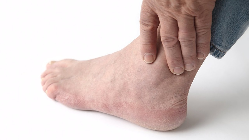 Mẹo chữa bệnh gout bằng lối sống lành mạnh 1