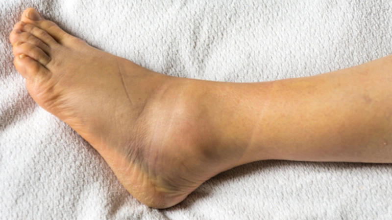 Bong gân mắt cá chân gây đau nhức, khó chịu cũng như hạn chế khả năng đi lại của người bệnh