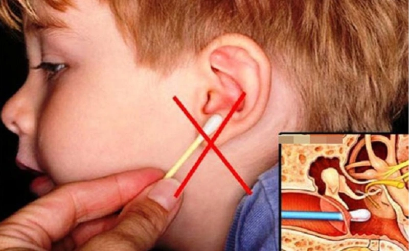 Mẹo lấy ráy tai khô cho bé 2