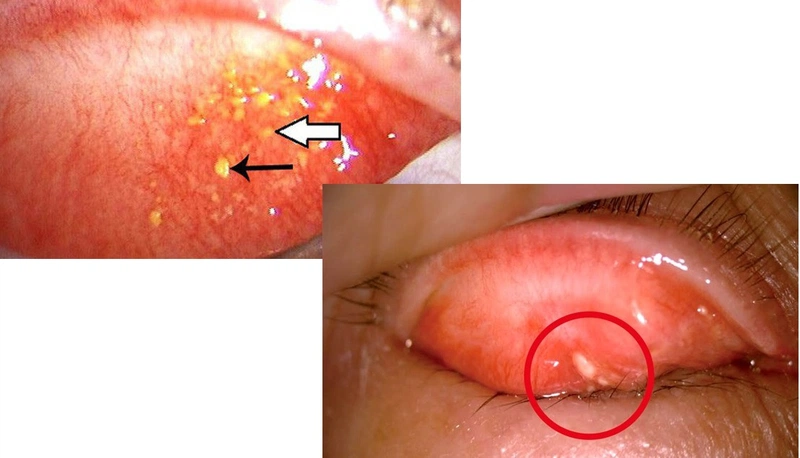 Triệu chứng đi kèm khi mí mắt trên nổi mụn trắng nhỏ