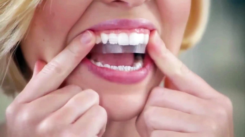 Miếng dán trắng răng mang lại hiệu quả làm trắng rỏ rệt, nhanh chóng