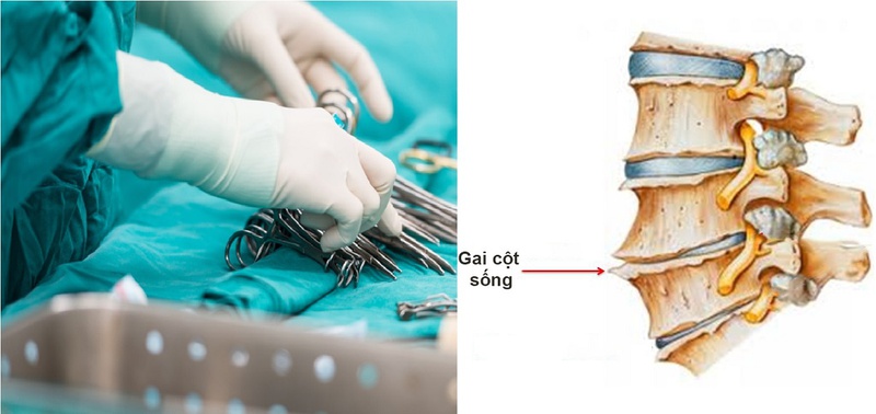 3 điều cần biết trước về mổ gai cột sống bằng phương pháp nội soi 2