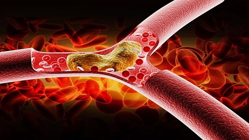 Hàm lượng mỡ máu phải dựa trên kết quả phân tích cholesterol toàn phần, LDL, HDL và triglyceride