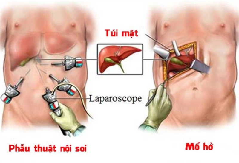 Mổ sỏi mật hết bao nhiêu tiền? Những lưu ý sau khi thực hiện phẫu thuật 2