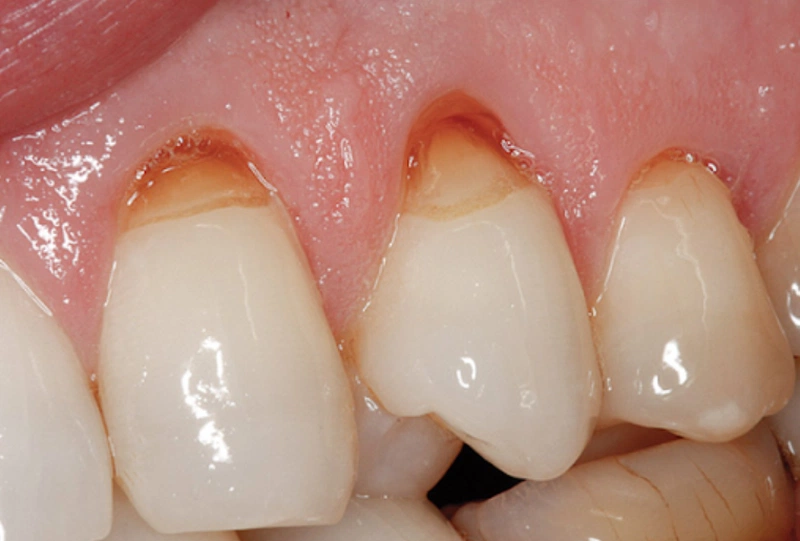 Đặc trưng của tình trạng mòn cổ chân răng là mất chất khu trú ở khu vực cổ răng, phần sát với lợi