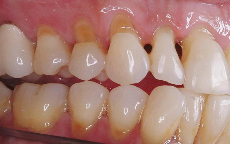 Có nhiều nguyên nhân khác nhau gây nên tình trạng mòn cổ chân răng