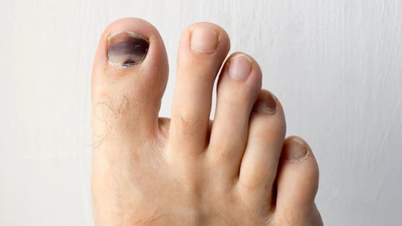 Móng chân bị đen có phải là dấu hiệu của bệnh lý nghiêm trọng không?1