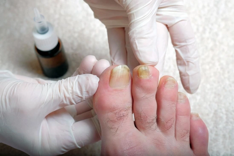 Móng chân bị gợn sóng có phải là dấu hiệu nguy hiểm