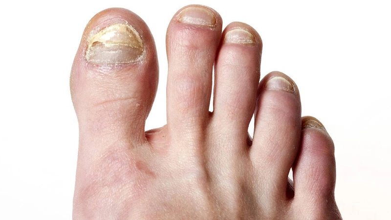 Móng chân bị gợn sóng có phải là dấu hiệu nguy hiểm