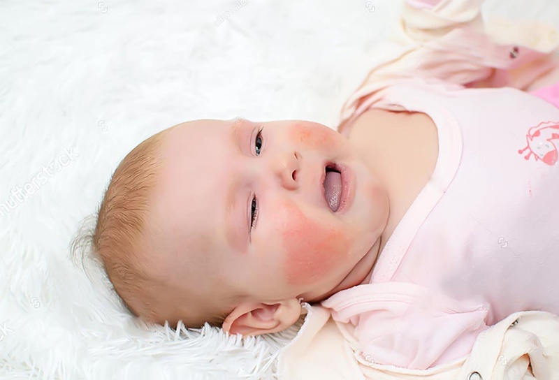 Một số bệnh dị ứng dễ gặp ở trẻ mà mẹ cần biết 1
