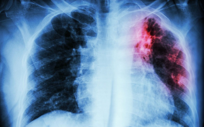 Bệnh lao phổi là bệnh khá phổ biến với tỷ lệ mắc bệnh cao