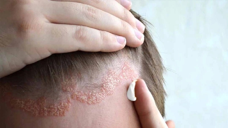 Các triệu chứng nấm da đầu có thể bao gồm xuất hiện các mảng hói cục bộ, da đóng vảy và ngứa