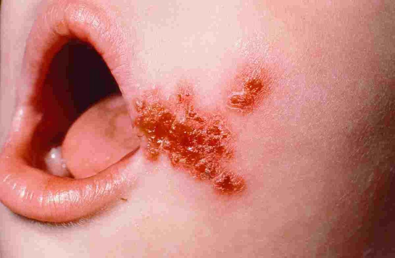 Một số bệnh ngoài da ở trẻ thường gặp nhất1