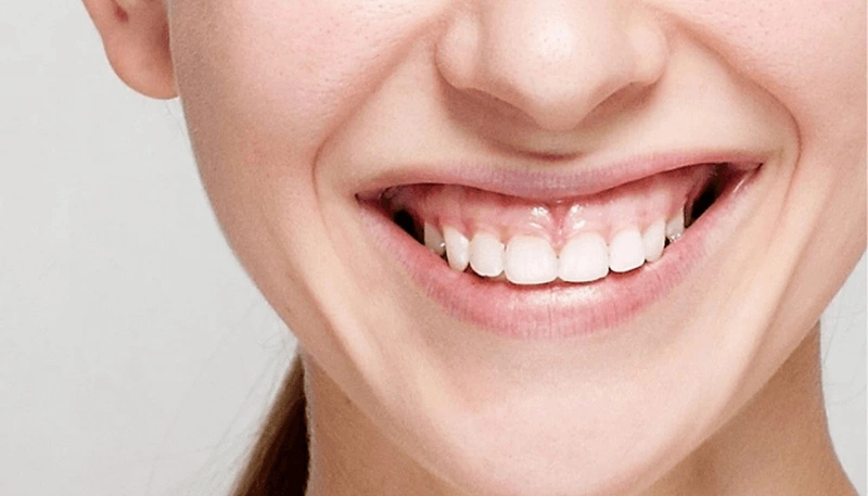 Tình trạng tụt lợi chân răng khiến răng của bạn bị dài ra trông thấy