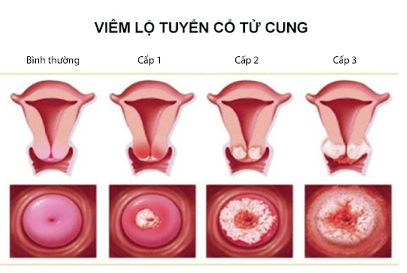 Một số kiến thức về viêm lộ tuyến cổ tử cung khí hư ra nhiều mà bạn cần quan tâm 1