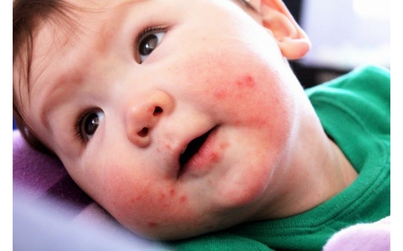 Một số lưu ý trong phòng và điều trị bệnh sởi cho trẻ nhỏ 1