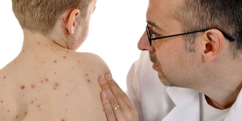 Một số lưu ý về thuốc bôi thủy đậu Acyclovir 2