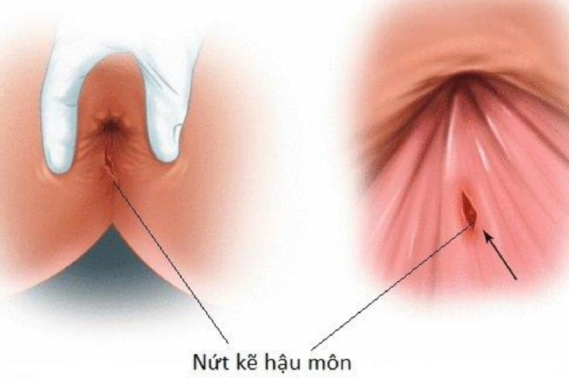 Nhận biết triệu chứng của bệnh nứt kẽ hậu môn 2