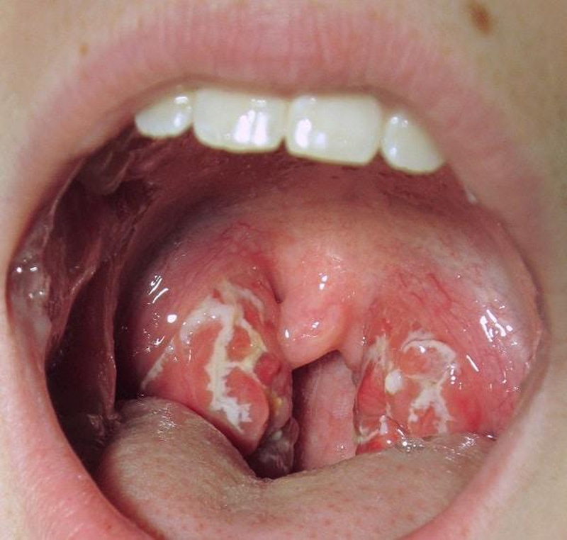 Một số phương pháp trị viêm họng hạt bằng đông y hiệu quả 1