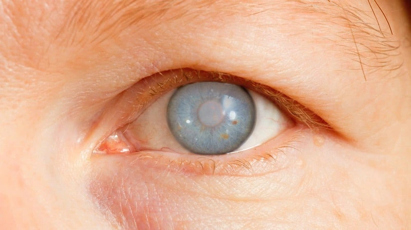 Một số thuốc điều trị Glaucoma bạn nên biết 1