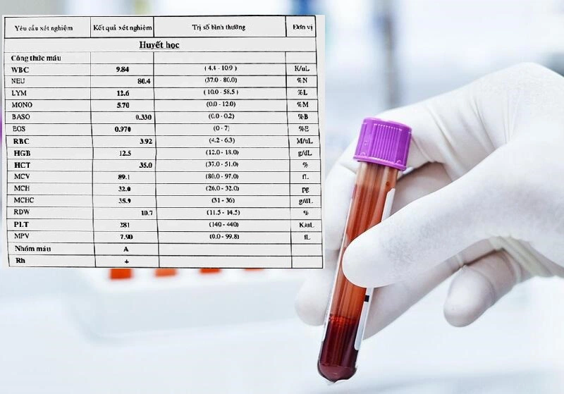 MPV trong xét nghiệm máu: Khám phá chỉ số bí ẩn và tầm quan trọng của nó đối với sức khỏe
