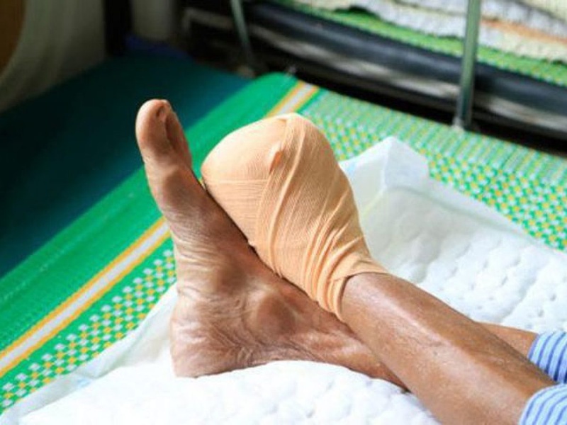 Mức độ nguy hiểm và cách phòng ngừa loét bàn chân tiểu đường 2