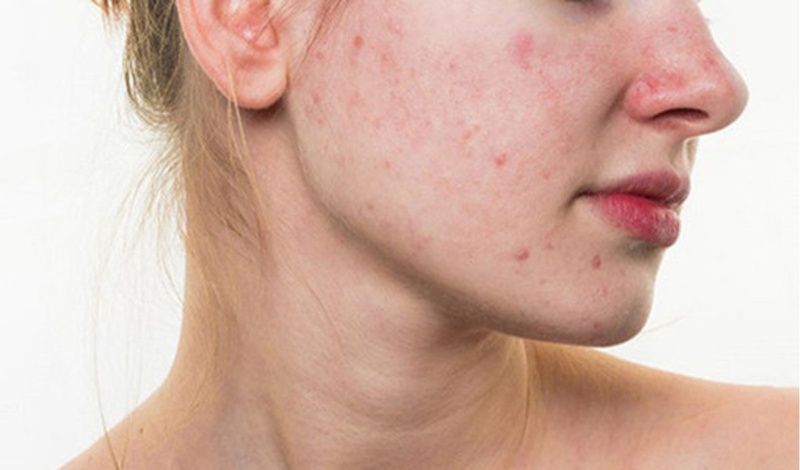 Mũi mẩn ngứa, nổi mụn khi ăn mì tôm sau nâng mũi