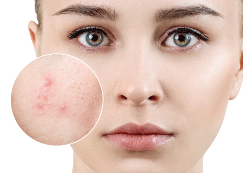 Mụn ẩn trên trán có nguy hiểm không?