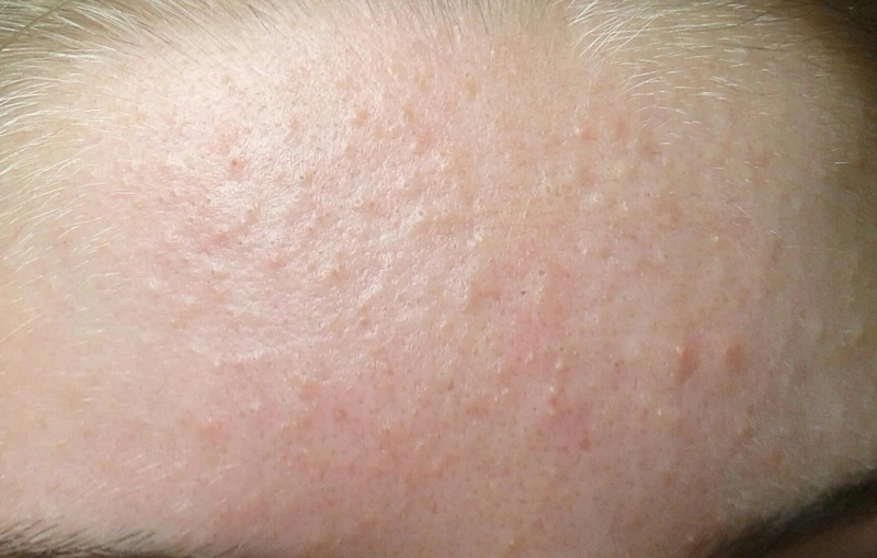 Mụn ẩn trên trán có nguy hiểm không?