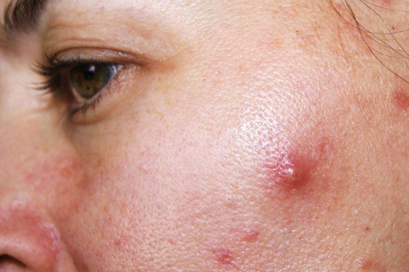 [Góc giải đáp] Hướng dẫn các cách điều trị mụn bọc không đầu 1
